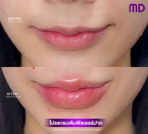 คุณบีมฟิลเลอร์ปาก