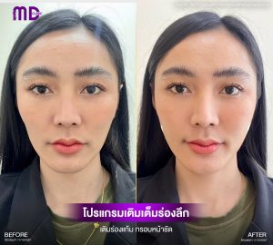 เอ็มดีคลินิก ฟิลเลอร์ร่องแก้มคุณเรย์