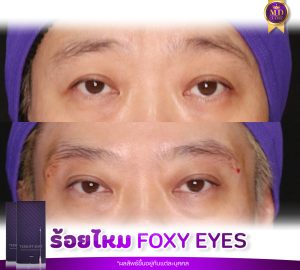 รีวิวร้อยไหมfoxy eyes