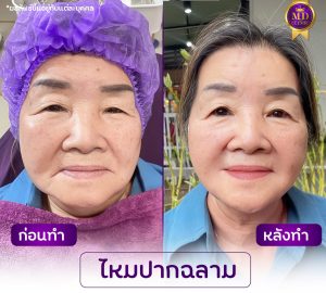 รีวิวร้อยไหมปากฉลาม