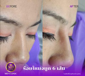 ร้อยไหมจมูกเอ็มดีคลินิก