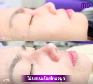 MD Clinic ร้อยไหมจมูก