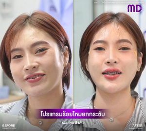 ร้อยไหมยกกระชับ คุณแพร