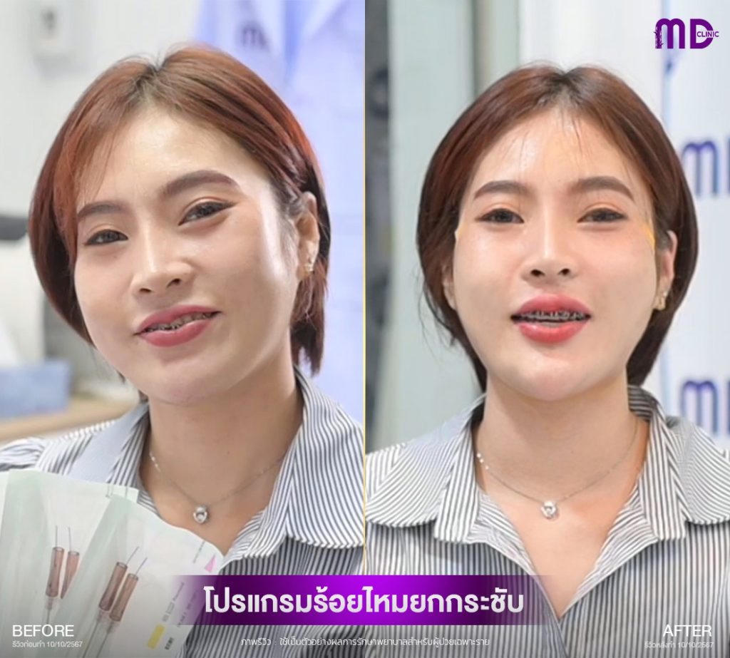ร้อยไหมยกกระชับ