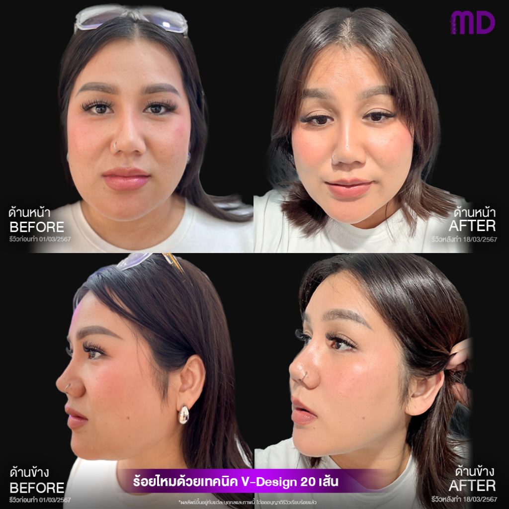 ร้อยไหม V design