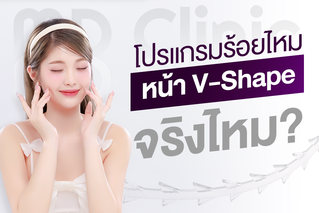 ร้อยไหมหน้า v-shape