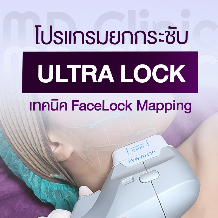 Ultra Lock