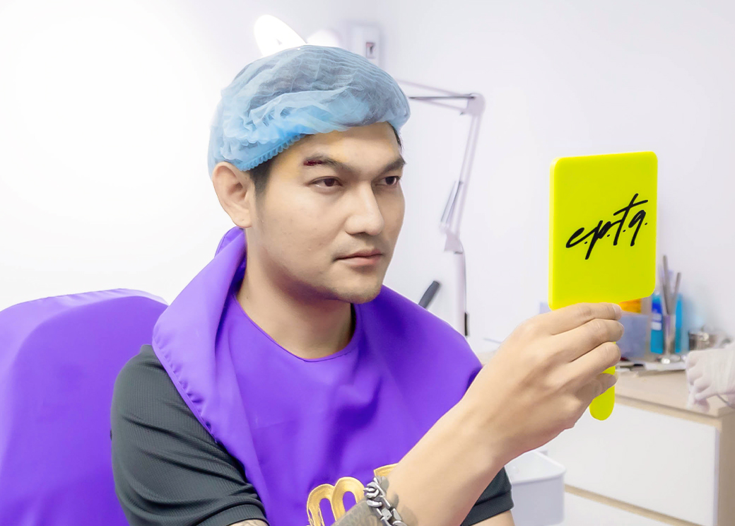 ร้อยไหมหางตา เอ็มดีคลินิก